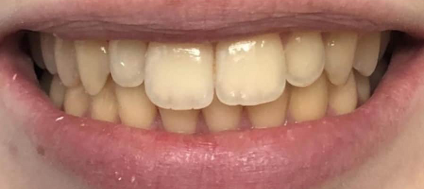 Before — Emily R.