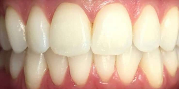 Before — James K.